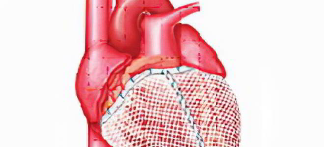 Гипертрофия обоих желудочков что это такое