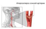 Атеросклеротическая бляшка в сонной артерии лечение