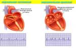 Аритмия сердца симптомы лечение первая помощь узи сердца