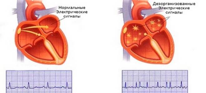 Аритмия сердца симптомы лечение первая помощь узи сердца