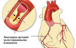 Инфаркт по задней стенке левого желудочка