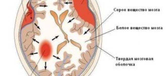 Гематома в голове после удара симптомы