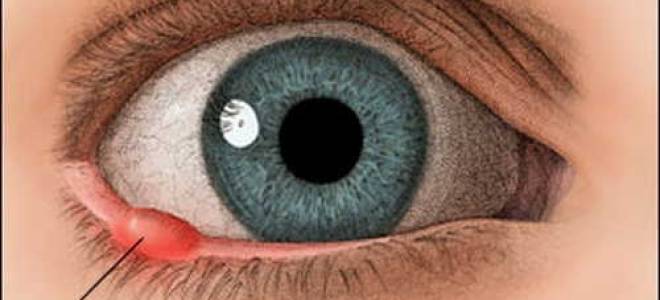 Инфаркт в глазу