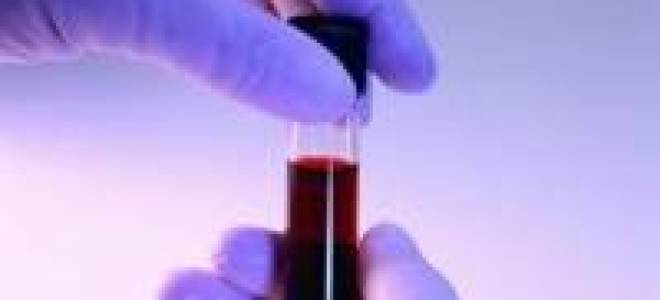 Двс синдром при беременности