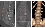 Аритмия при остеохондрозе шейного отдела позвоночника