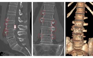 Аритмия при остеохондрозе шейного отдела позвоночника