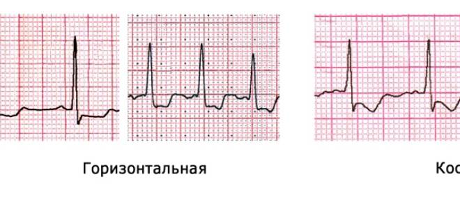 Ишемия миокарда левого желудочка экг