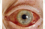 Жалобы при остром приступе глаукомы