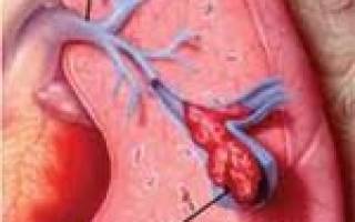 Инфаркт легкого при тромбоэмболии