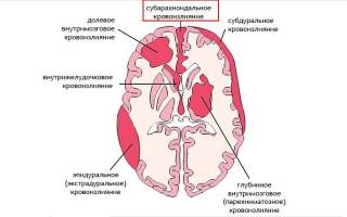 Арахноидальное кровоизлияние в мозг последствия