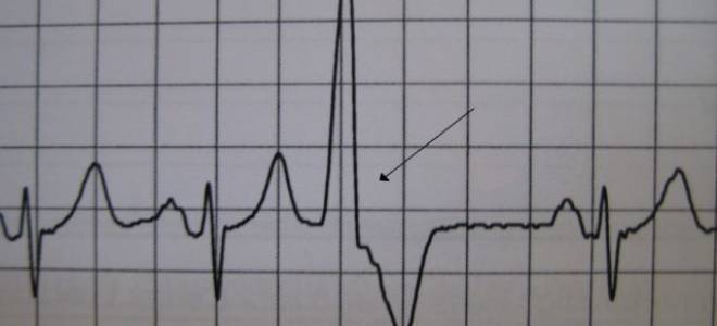 Желудочковая экстрасистолия по типу тригеминии лечение