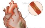 Инфаркт миокарда признаки причины неотложная помощь