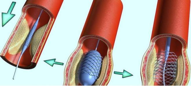 Втэк после инфаркта