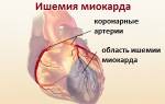 Дилатационная кардиомиопатия ишемическая