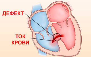Врожденный порок сердца дефект межпредсердной перегородки у детей