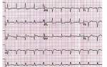 Вид кардиограммы при инфаркте