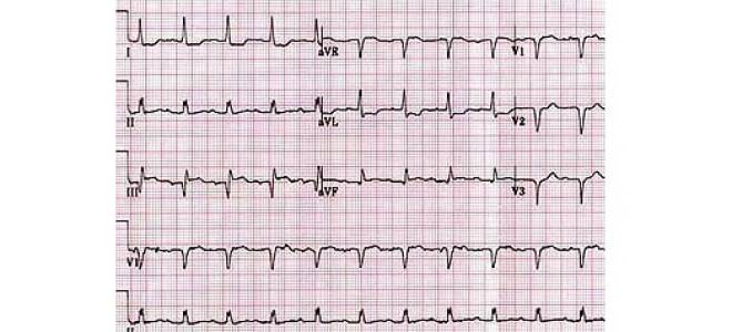Инфаркт миокарда экг локализация