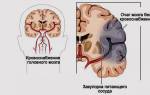 Инфаркт мозга в вертебробазилярном бассейне