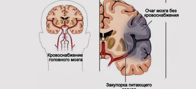 Инфаркт мозга в вертебробазилярном бассейне