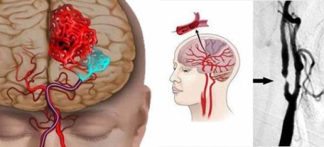 Ишемия головного мозга