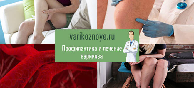 Если болят вены на ногах какую мазь применять