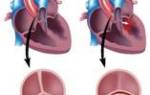Врожденный порок сердца аортальный двустворчатый