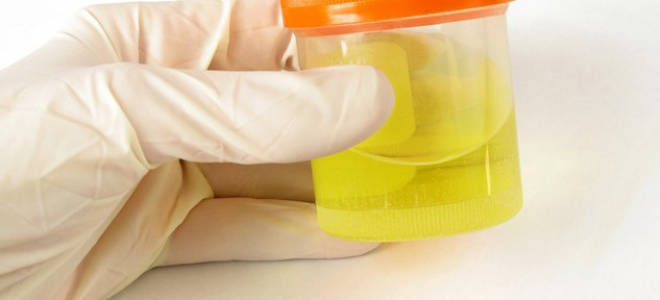 Ионизированный кальций в моче