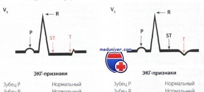 Депрессия в ишемии