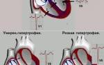 Гипертрофия миокарда правого желудочка сердца что это такое