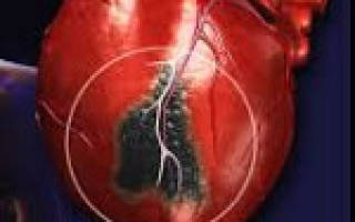Заболевания сердечно сосудистой системы инфаркт миокарда