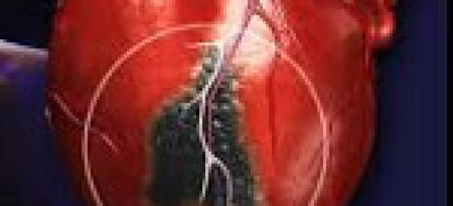 В следствии чего возникает инфаркт миокарда