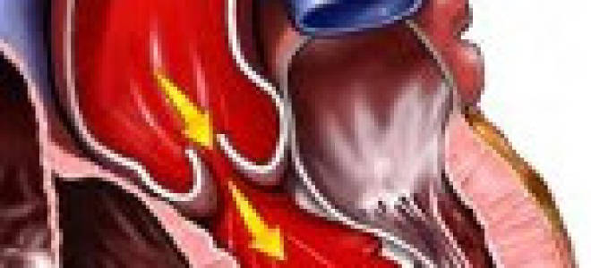 Изменение гемодинамики при аортальной недостаточности