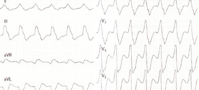 Изменения на экг при пароксизмальной тахикардии