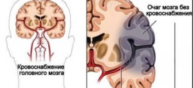 Инфаркт мозга прогноз для жизни