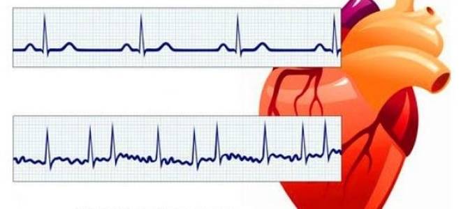 Как быстро убрать аритмию сердца в домашних условиях