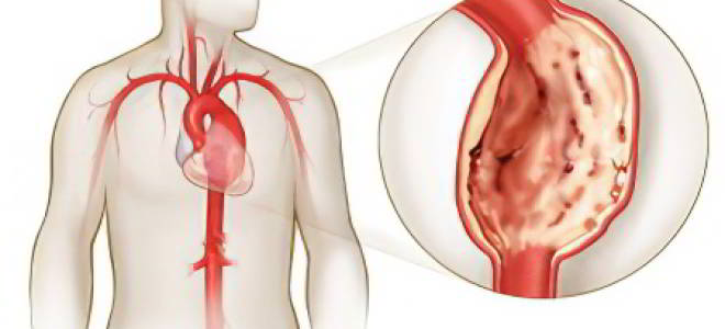 Аневризма сердца что это такое насколько это опасно